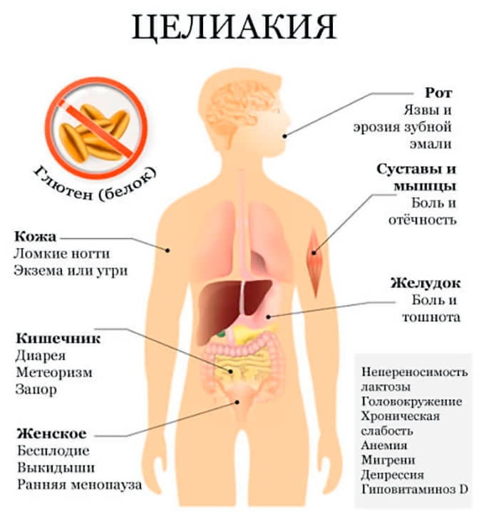 как проявляется целиакия
