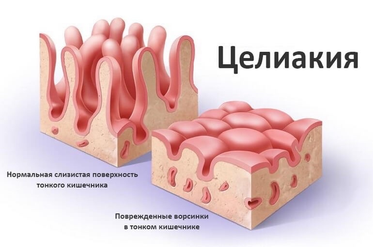 целиакия что это такое